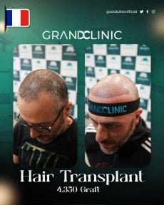 before-after photo hair-transplant