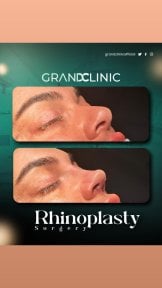 before-after photo rhinoplasty-nose-job