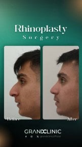 before-after photo rhinoplasty-nose-job
