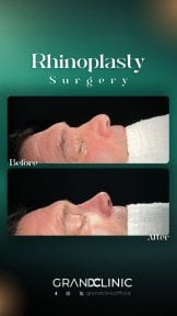 before-after photo rhinoplasty-nose-job