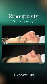 before-after photo rhinoplasty-nose-job