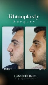 before-after photo rhinoplasty-nose-job