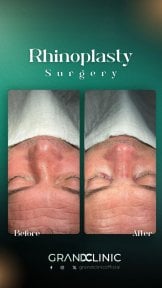 before-after photo rhinoplasty-nose-job