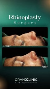 before-after photo rhinoplasty-nose-job