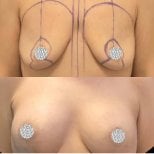 Before and after mammoplasty results at Turan Turan Health Group, breast lift and contouring