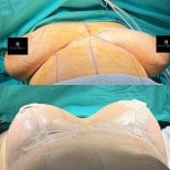 Before and after mammoplasty results at Turan Turan Health Group, breast reshaping surgery