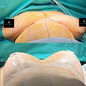 before-after photo breast-reduction