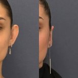 Before and after Ear Reconstruction photos by Dr. 