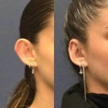Before and after Ear Reconstruction photos by Dr. 