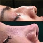 Before and after Tip rhinoplasty  photos by Dr. 