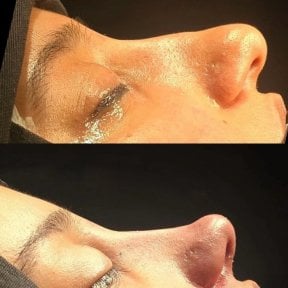 Before and after rhinoplasty results at Turan Turan Health Group, improved nose profile