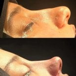 Before and after rhinoplasty results at Turan Turan Health Group, improved nose profile