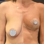 Zdjęcia przed i po Podniesienie piersi z powiększeniem za pomocą okrągłych implantów wykonane przez dr. 