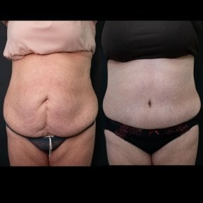 before-after photo abdominoplasty