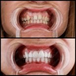 Hollywood Smile before and after results at Mira Clinic, dental veneers for smile makeover