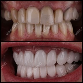 Hollywood Smile Vorher-Nachher-Ergebnis bei Mira Clinic, Veneers für weiße Zähne