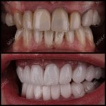 Hollywood Smile Vorher-Nachher-Ergebnis bei Mira Clinic, Veneers für weiße Zähne
