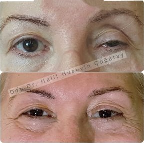 before-after photo prosthetic-eye