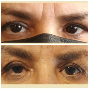 before-after photo strabismus-surgery