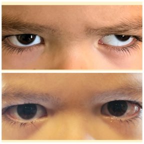 before-after photo strabismus-surgery