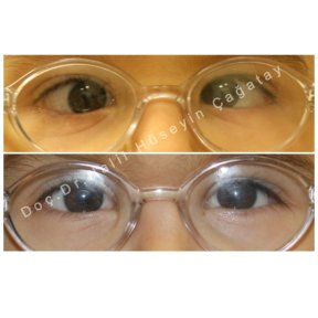 before-after photo strabismus-surgery