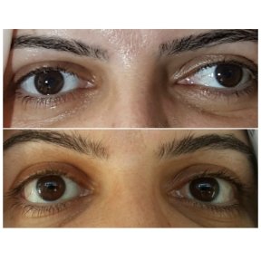 before-after photo strabismus-surgery