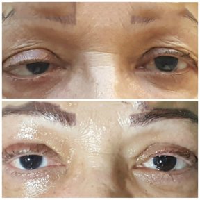 before-after photo strabismus-surgery