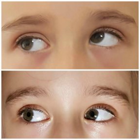 before-after photo strabismus-surgery