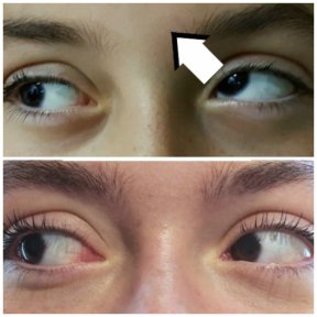 before-after photo strabismus-surgery