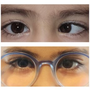 before-after photo strabismus-surgery