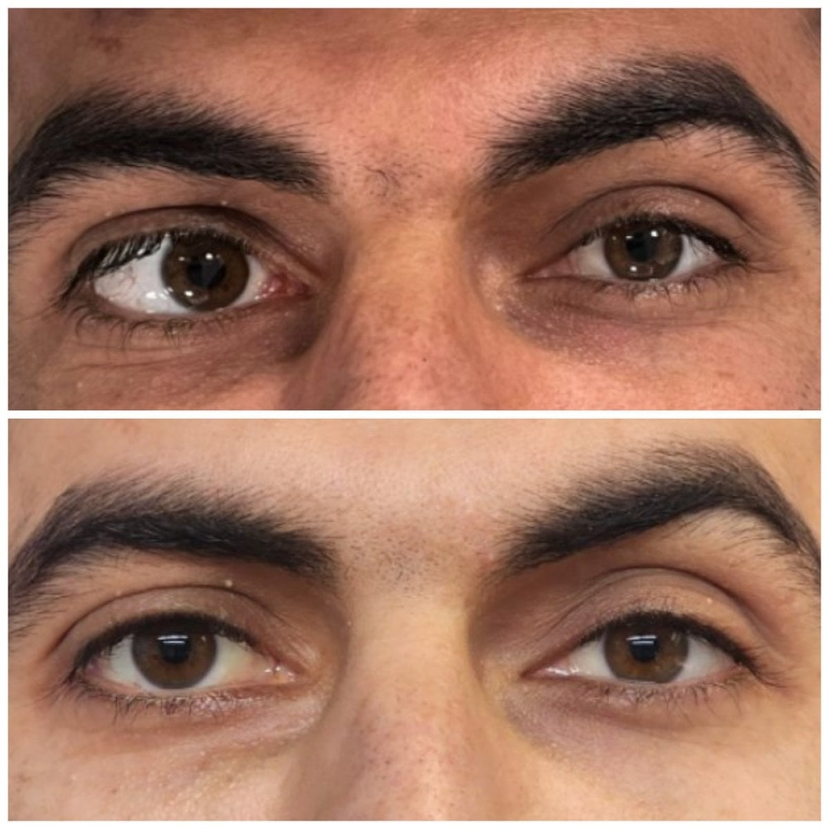نتيجة قبل وبعد جراحة الحول في عيادة DrCagatay Eye Clinic، تحسين محاذاة العينين