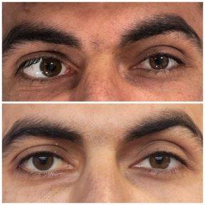 before-after photo strabismus-surgery