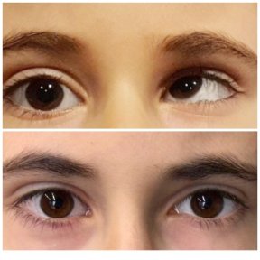 before-after photo strabismus-surgery