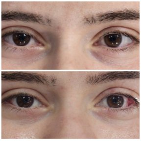 before-after photo strabismus-surgery