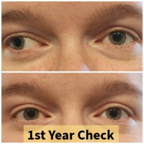 before-after photo strabismus-surgery