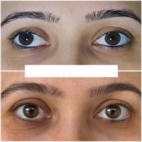before-after photo strabismus-surgery