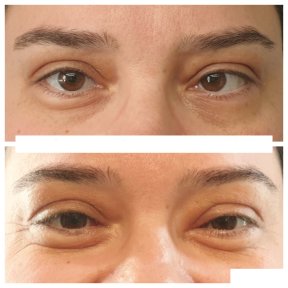 before-after photo strabismus-surgery