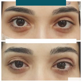before-after photo strabismus-surgery