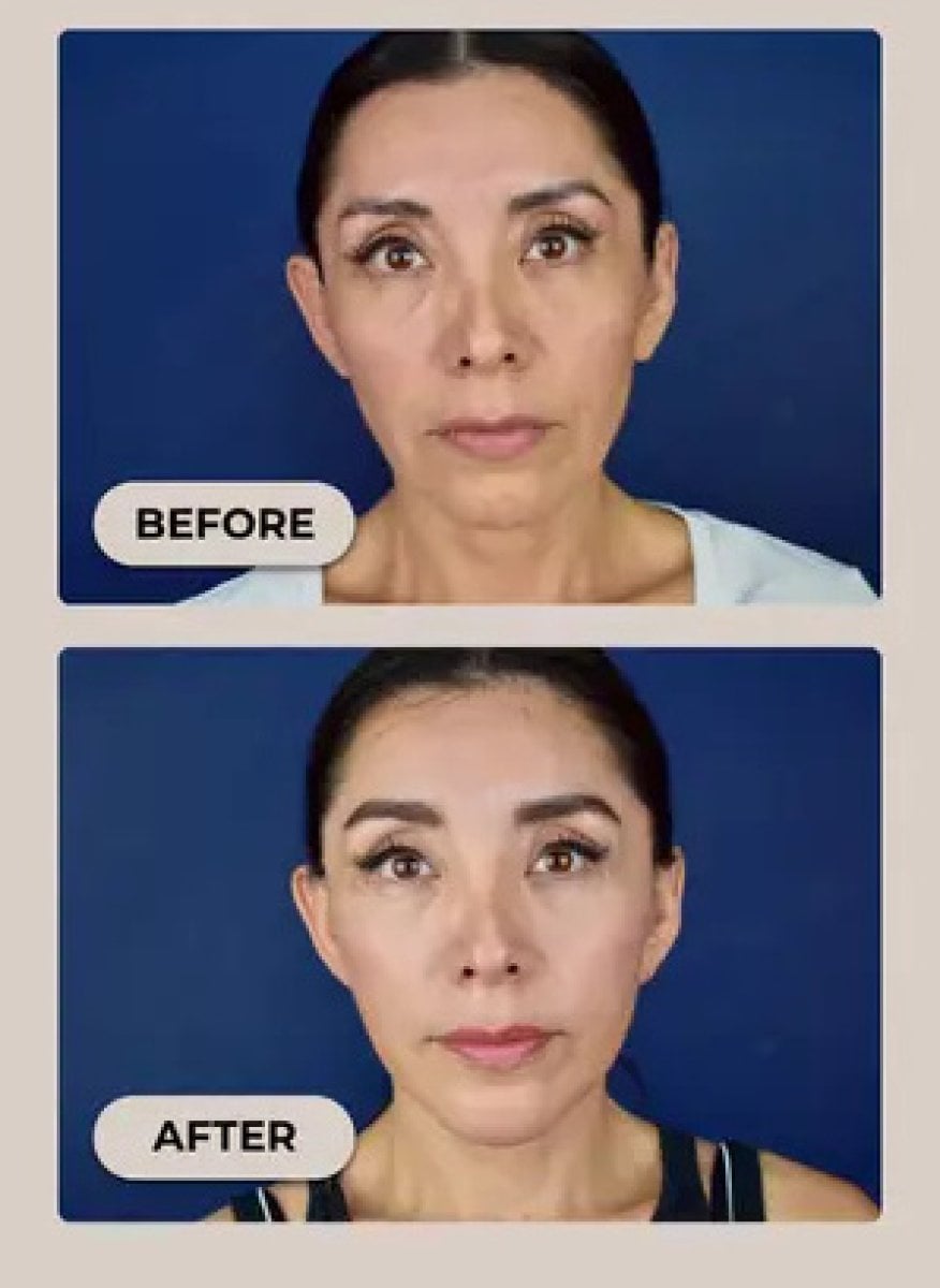 Resultados de lifting facial antes y después – rejuvenecimiento y piel más firme