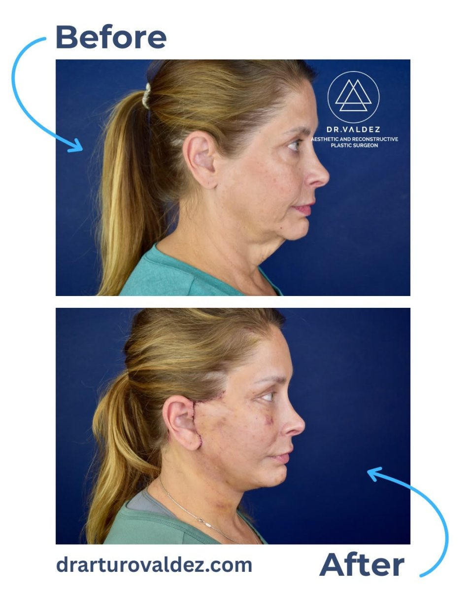 Resultados de lifting de cuello antes y después en Dr. Valdez – cuello y mandíbula definidos