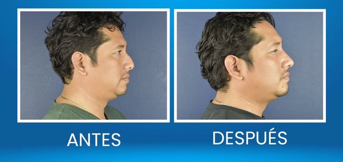 Resultados de rinoplastia antes y después en hombre, perfil y contorno nasal mejorados