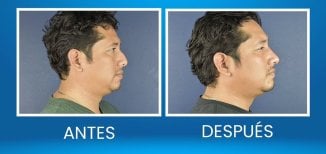 Resultados de rinoplastia antes y después en hombre, perfil y contorno nasal mejorados