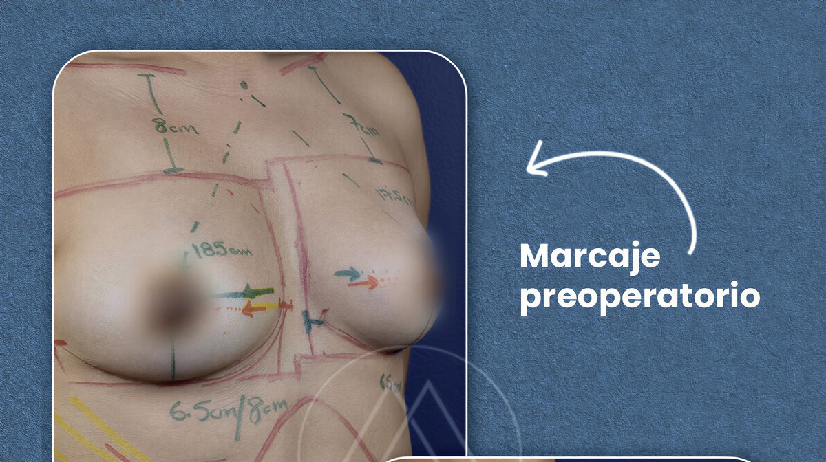 Marcaje preoperatorio para mastopexia, planificación de incisiones y resultado esperado
