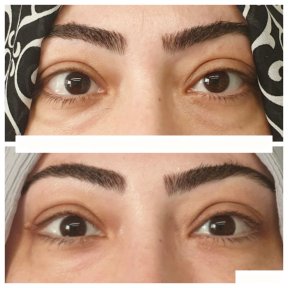 before-after photo strabismus-surgery