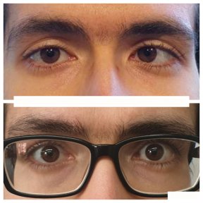 before-after photo strabismus-surgery