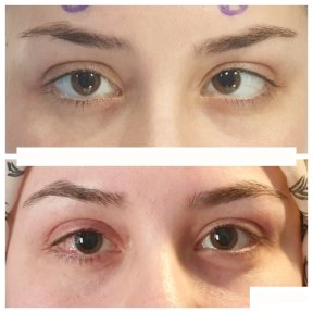 before-after photo strabismus-surgery