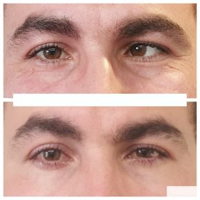 before-after photo strabismus-surgery