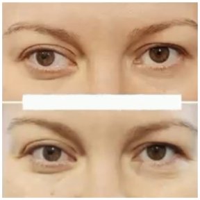 before-after photo strabismus-surgery
