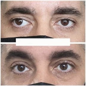 before-after photo strabismus-surgery