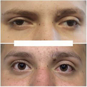 before-after photo strabismus-surgery